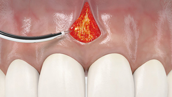 歯肉切開・切除